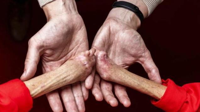 Servicio de Atención psicosocial. "La Porfiria existe"
