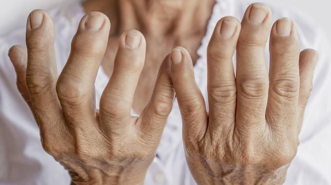 Proyecto para la mejora de la calidad de vida de las personas con artritis