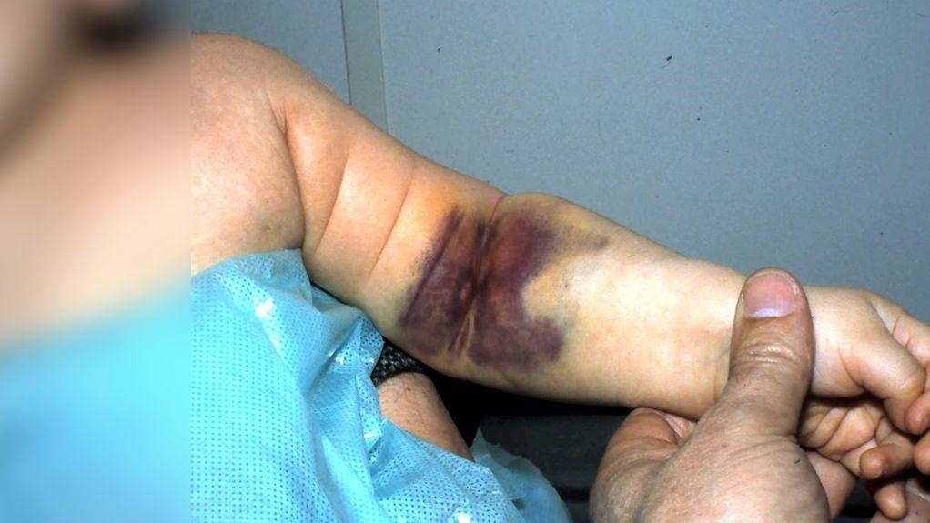 Programa de bienestar integral para personas con hemofilia y otras coagulopatías congénitas