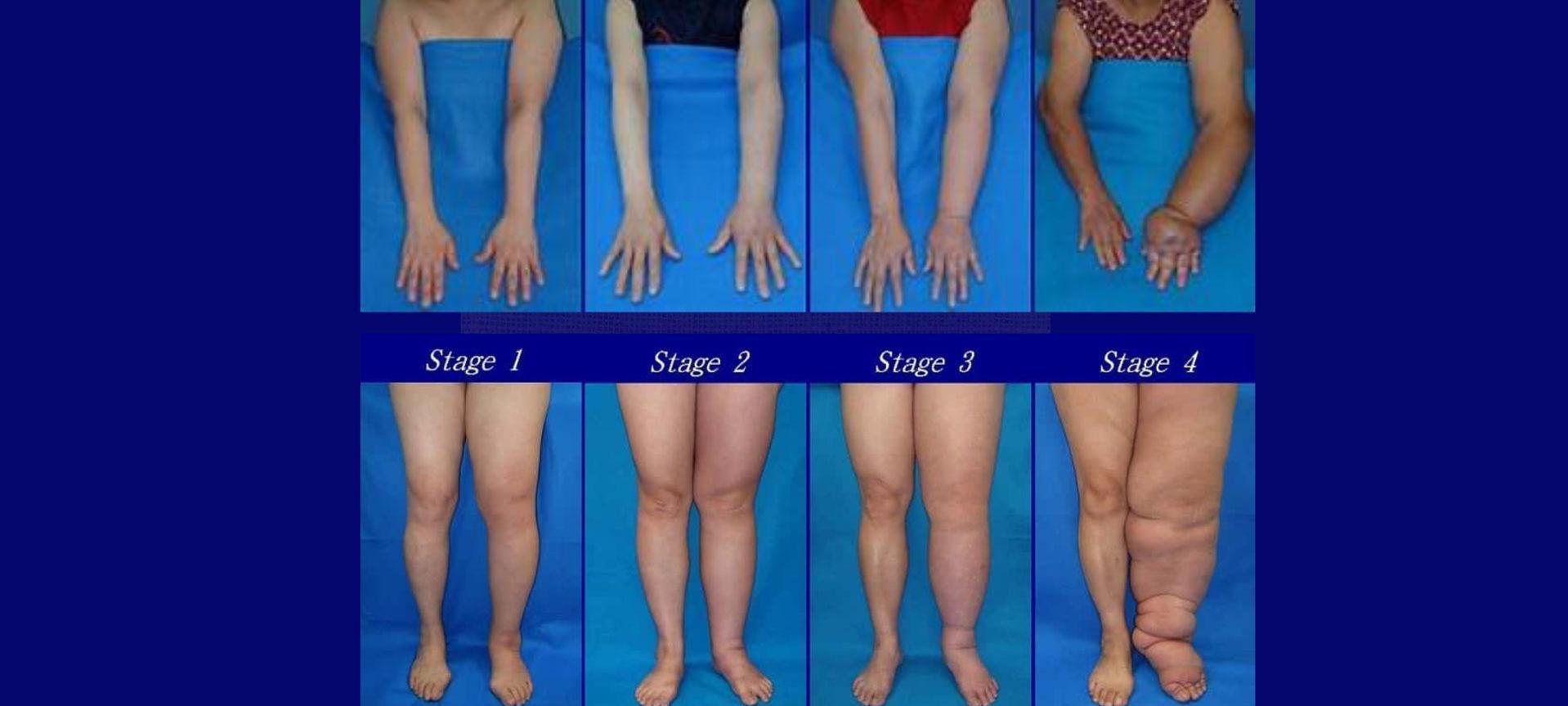 Asociación Galega de Linfedema, Lipedema, Insuficiencia Venosa Crónica - Su perfil. Votar, valora y comunicate